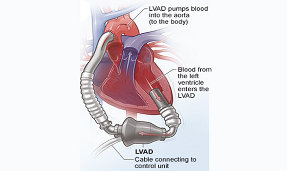 LVAD Cost in India